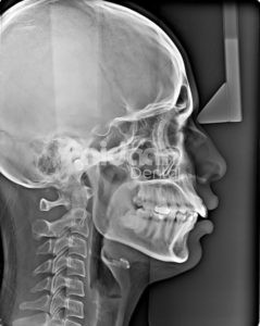 Lateral Cephalogram